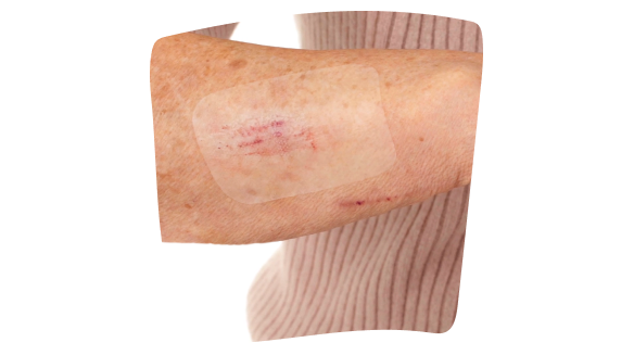 Persona con Leukomed® T skin sensitive applicato sul braccio per coprire graffi su una pelle affetta da dermatite atopica. Persona con Leukomed® T skin sensitive applicato sul braccio per coprire graffi su una pelle affetta da dermatite atopica.